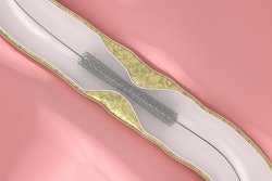 Coronary stent