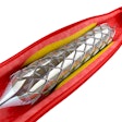 Angioplasty stent