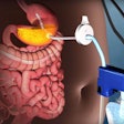 AspireAssist Stomach Pump. Image: Aspire Bariatrics