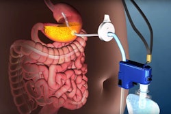 AspireAssist Stomach Pump. Image: Aspire Bariatrics