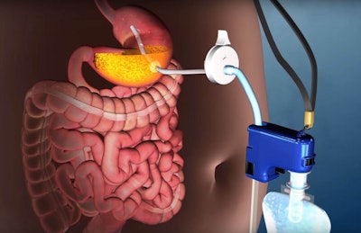 AspireAssist Stomach Pump. Image: Aspire Bariatrics