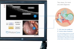 PhotoniCare Intervace / Photo: Photonicare, Inc.