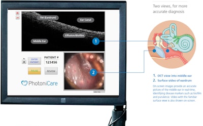 PhotoniCare Intervace / Photo: Photonicare, Inc.