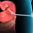 Gastric Emptying System / Image: Aspire Bariatrics