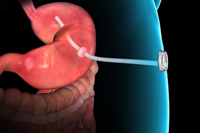 Gastric Emptying System / Image: Aspire Bariatrics