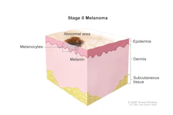 Melanoma / Image: Terese Winslow