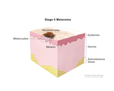 Melanoma / Image: Terese Winslow