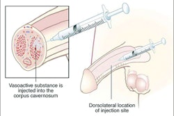 Endo's Edex Injection / Image: edguidance.com