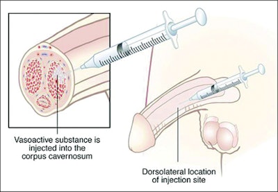 Endo's Edex Injection / Image: edguidance.com