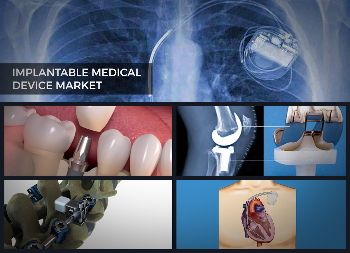 Implantable Medical Devices Market to show Solid Global Growth