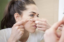 Adult acne is on the rise. / Image: Shutterstock