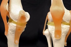 3D-Printable Knee / Image: Feichen Yang, Duke