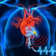 Body-Powered Pacemaker / Image: UCLA