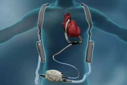 HeartMate II / Image: Thoratec