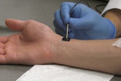 Nanochip on skin getting the magic touch. Image: Ohio State University
