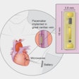 Wireless Pacemaker Diagram / Image: Mehdi Razavi