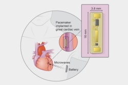 Wireless Pacemaker Diagram / Image: Mehdi Razavi
