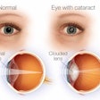 Cataract Anatomy / Image: Vision Works