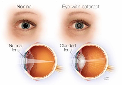 Cataract Anatomy / Image: Vision Works