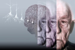 Fighting Alzheimer's with brain stimulation. / Image: Getty Images