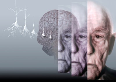 Fighting Alzheimer's with brain stimulation. / Image: Getty Images
