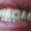 Tooth Sensor / Image: Tufts