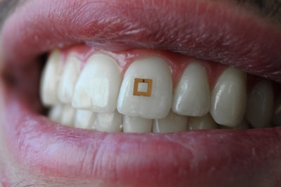 Tooth Sensor / Image: Tufts
