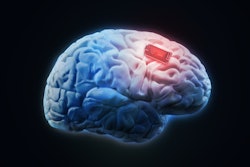 Neural Implant / Image: Alzheimer's News