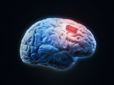 Neural Implant / Image: Alzheimer's News