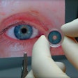 Artificial Iris / Image: HumanOptics