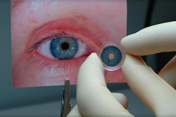 Artificial Iris / Image: HumanOptics