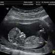 Ultrasound / Image: WIkipedia