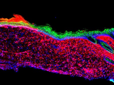 Epithelial (skin) tissues were generated by converting one cell type (red: mesenchymal cells) to another (green: basal keratinocytes) within a large ulcer in a laboratory mouse model / Image: Salk Institute