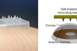 Spiky Eye Patch Drug Delivery System / Image: Nature