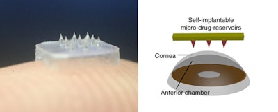 Spiky Eye Patch Drug Delivery System / Image: Nature