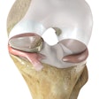 NUsurface Meniscus Implant / Image: Active Implants