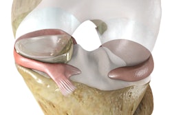 NUsurface Meniscus Implant / Image: Active Implants