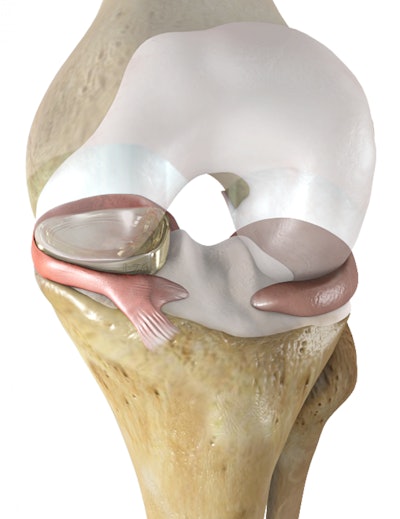 NUsurface Meniscus Implant / Image: Active Implants