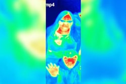 Tourist Attraction Thermal Camera Spots Breast Cancer