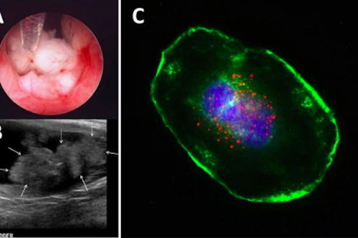Treating Bladder Cancer