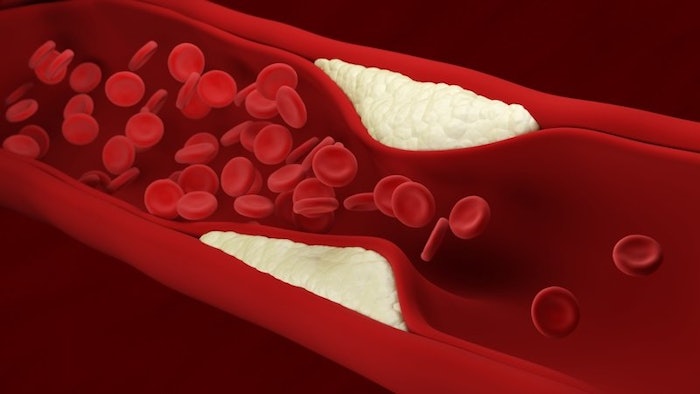 Atherosclerotic plaque in blood vessel.