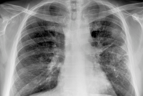Lung Cancer
