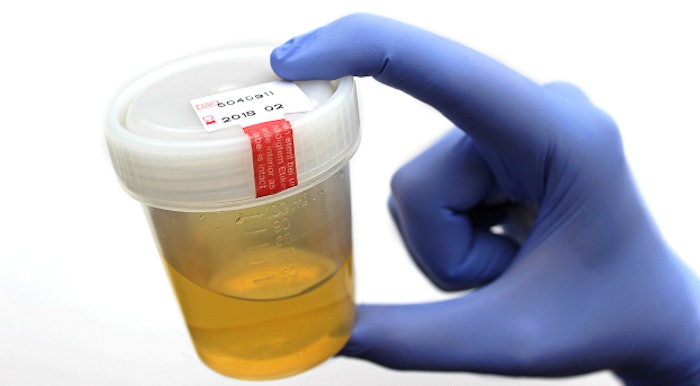 urine sample prostate cancer