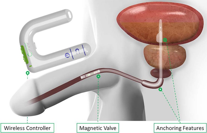 Connected Catheter