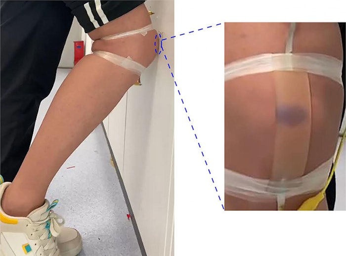 Artificial Bruised Skin