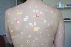 Ai Skin Cancer Detection