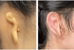 Microtia Congenital Ear Institute