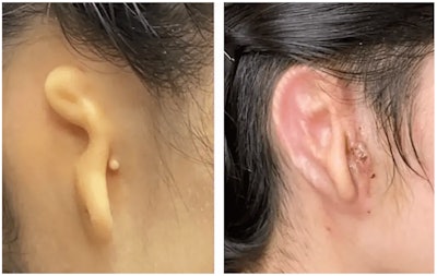 Microtia Congenital Ear Institute