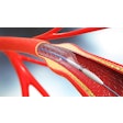 Tekni Plex Catheter Stent