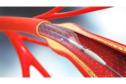 Tekni Plex Catheter Stent